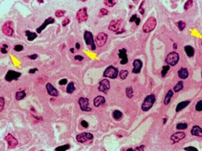 怀疑是系统性红斑狼疮肾炎需要做哪些检查?