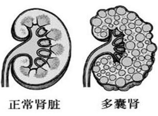 肾囊肿和多囊肾是一种疾病吗？多囊肾是怎么回事？